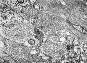 M,12y. | fibrillary astrocytoma